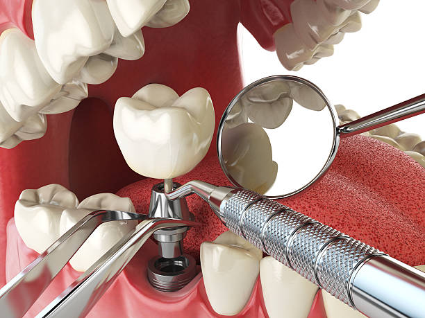 Best Emergency Tooth Extraction in Glasgow, VA